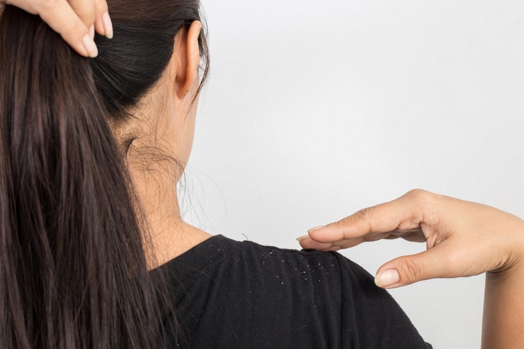  Mulher de costas, segurando o cabelo como em um rabo de cavalo; e a blusa preta cheia de pontinhos brancos de caspa