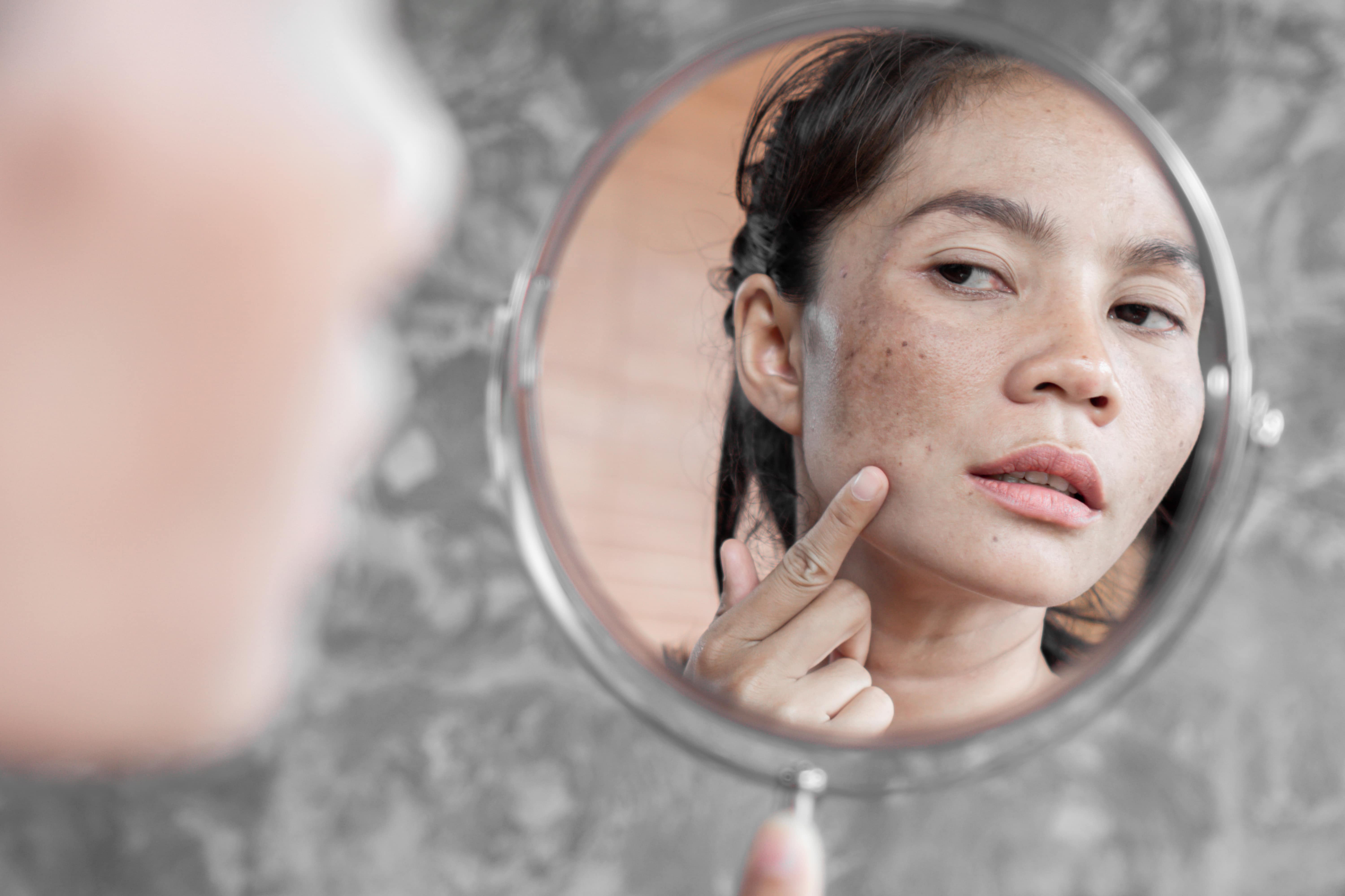 Melasma: o que é, sintomas, causas, tratamentos e prevenção